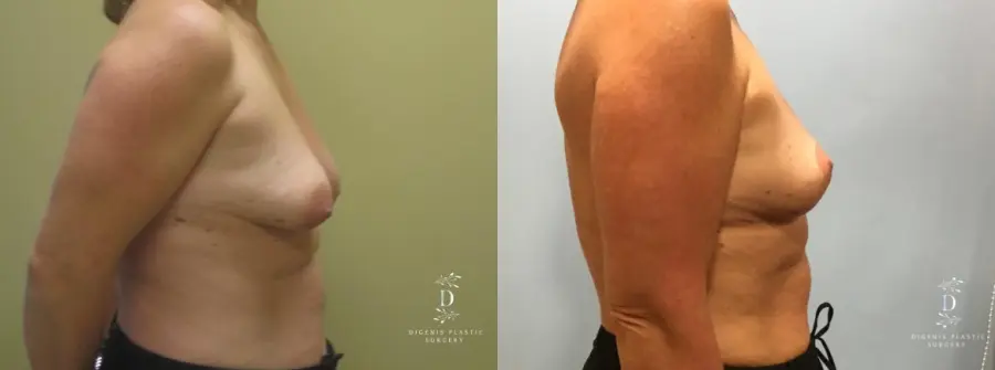 Breast Lift: Patient 9 - Before and After 4