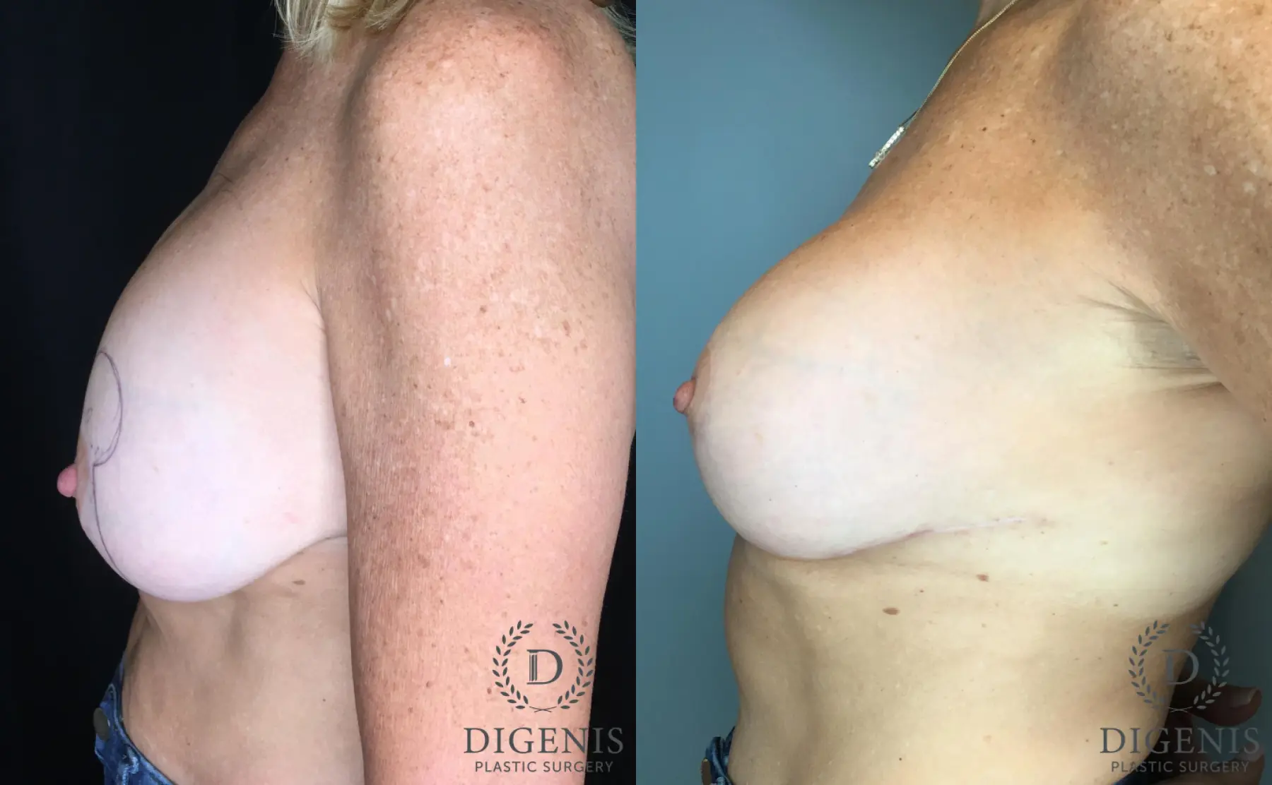 Breast Lift: Patient 45 - Before and After 3