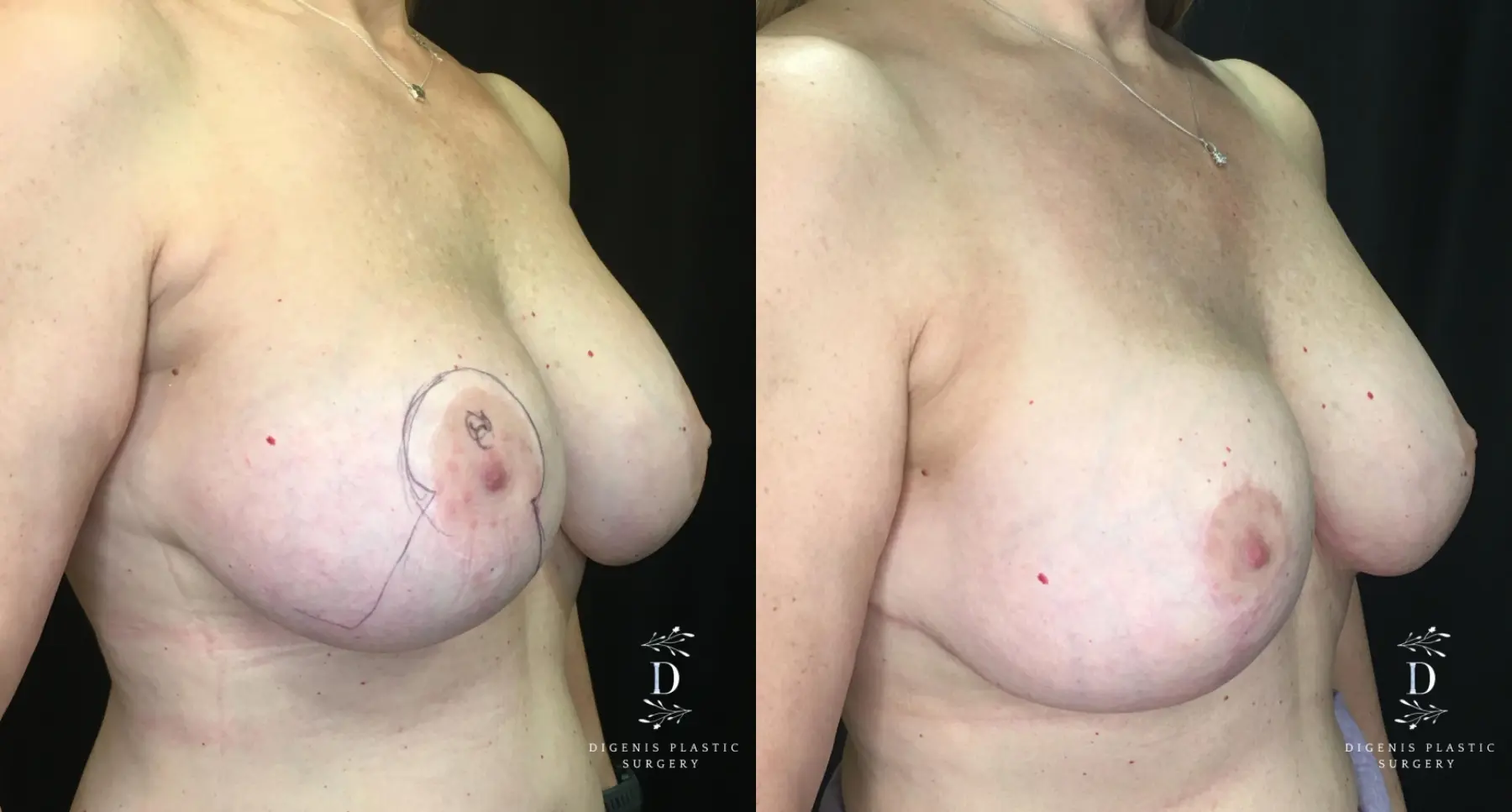 Breast Lift: Patient 23 - Before and After 2