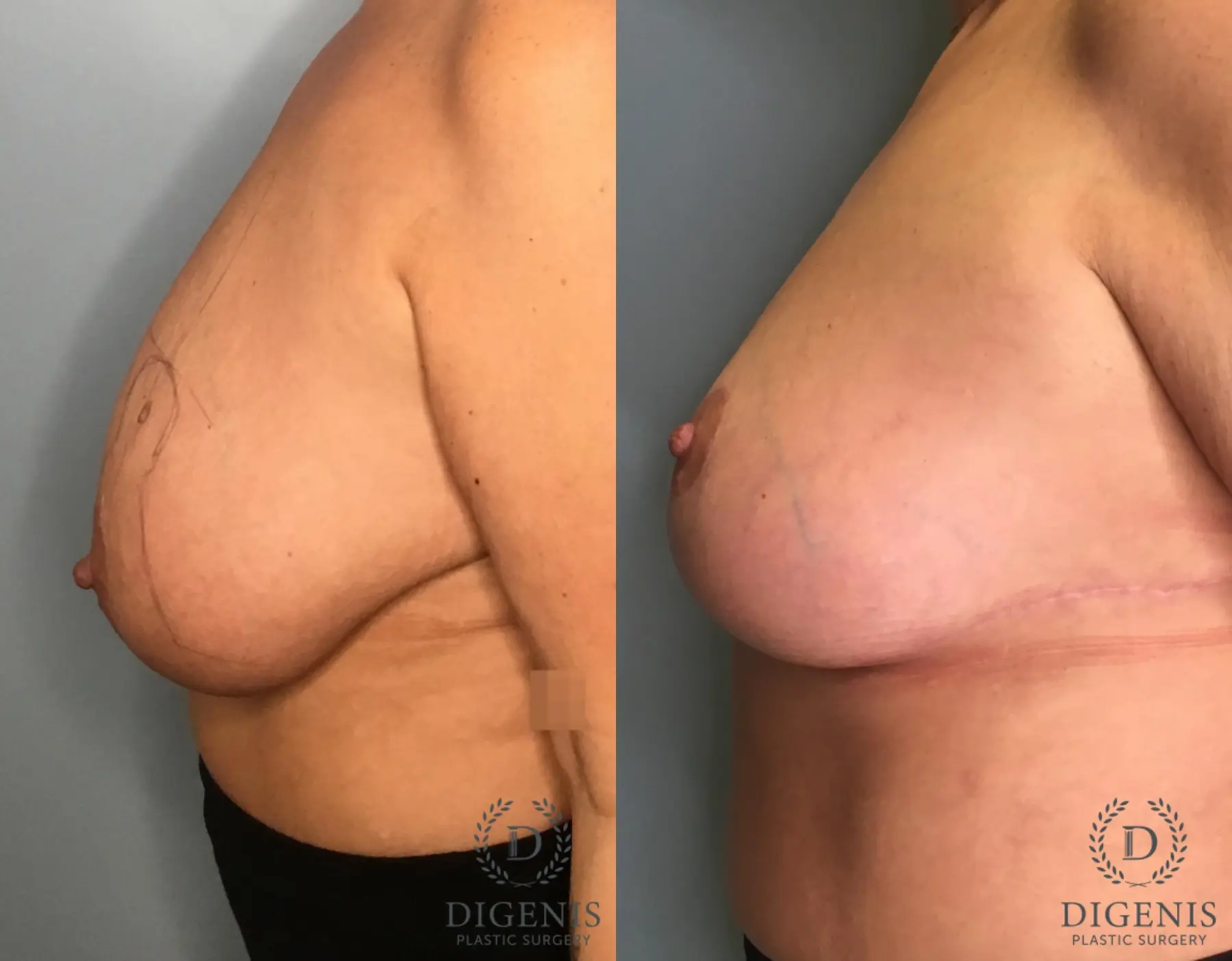 Breast Lift: Patient 44 - Before and After 5