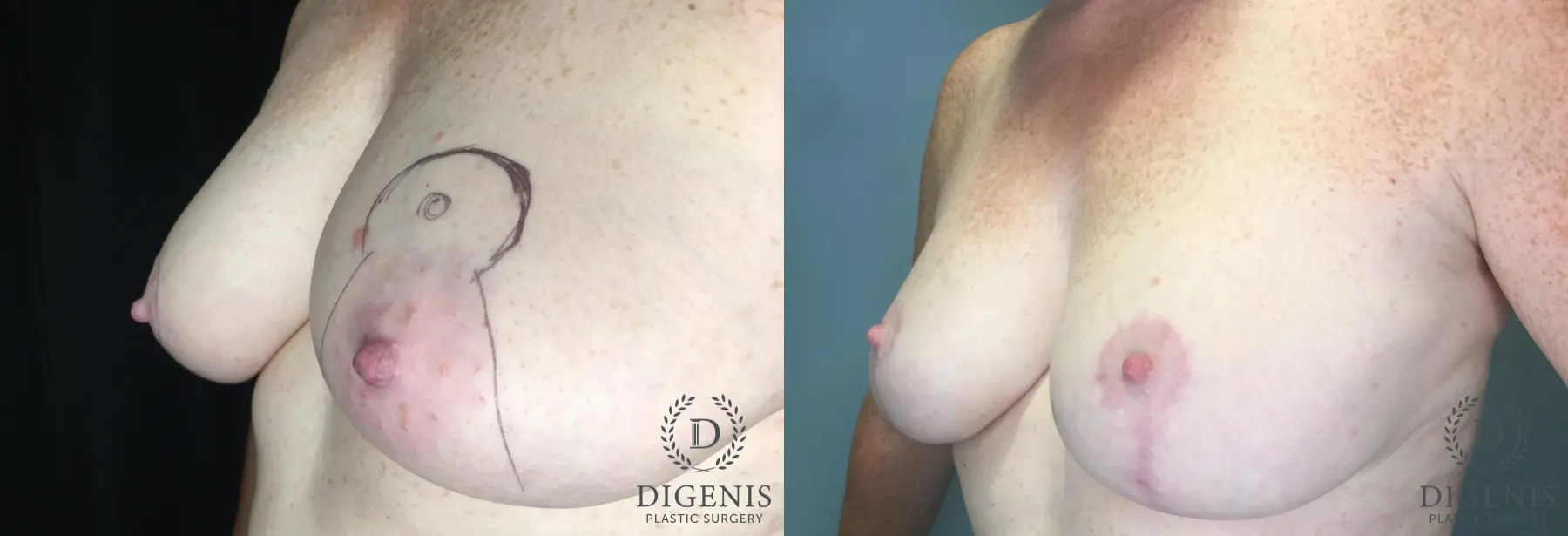 Breast Lift: Patient 35 - Before and After 2