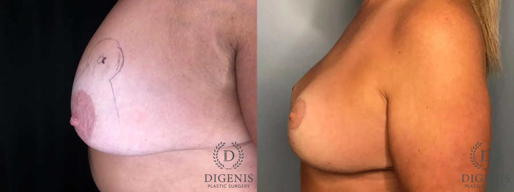 Breast Lift: Patient 33 - Before and After 3
