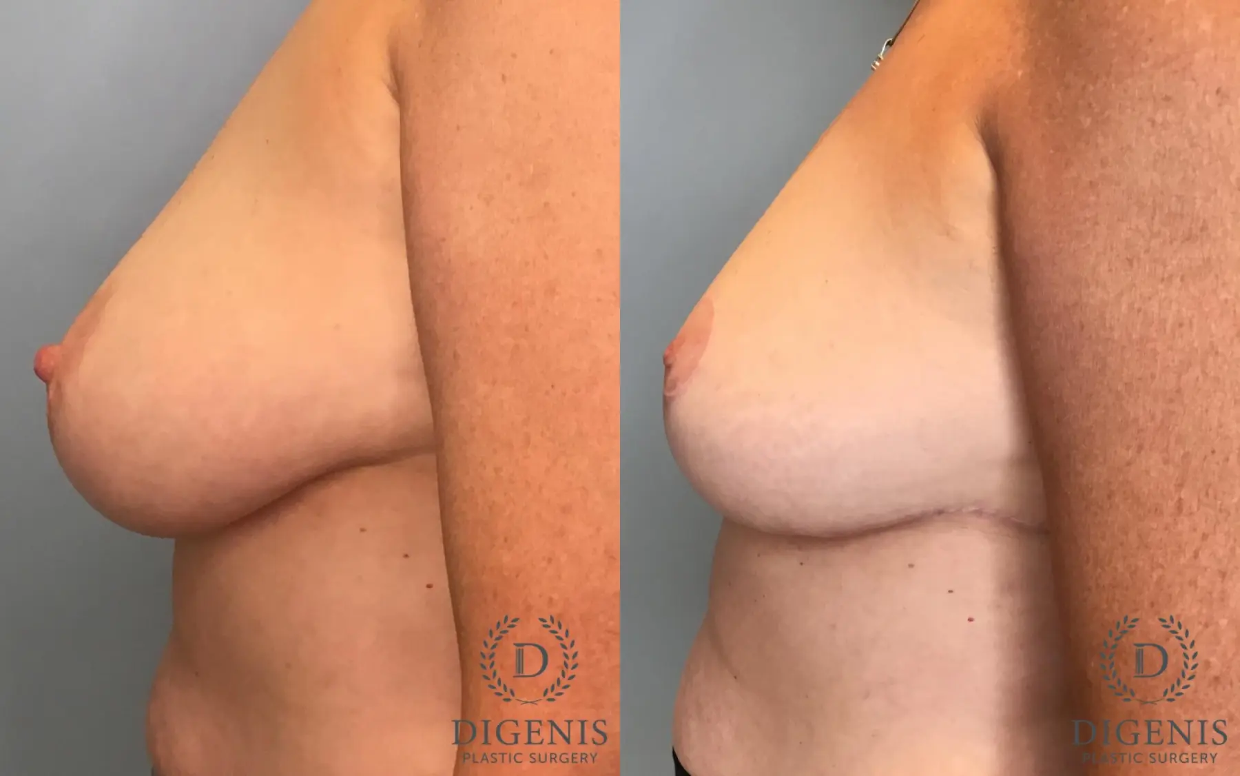 Breast Lift: Patient 46 - Before and After 5