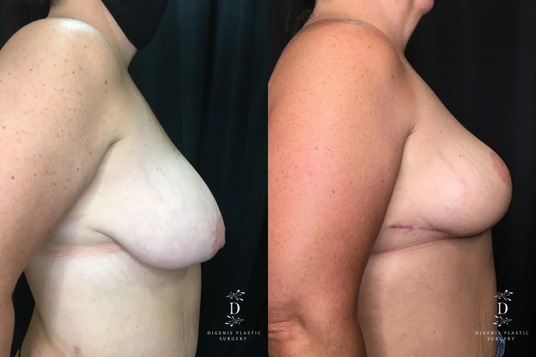 Breast Lift: Patient 10 - Before and After 3