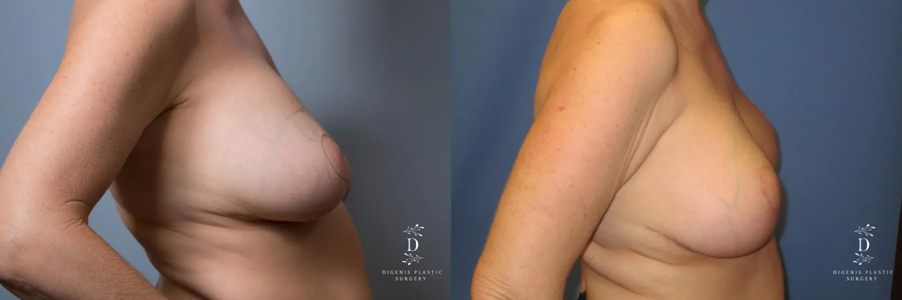 Breast Lift: Patient 6 - Before and After 3