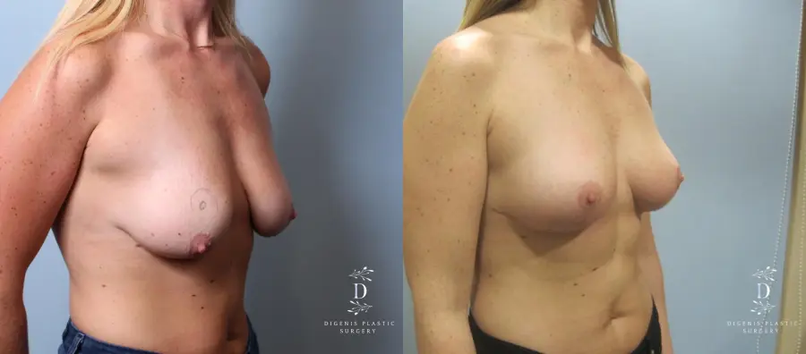 Breast Lift: Patient 7 - Before and After 2