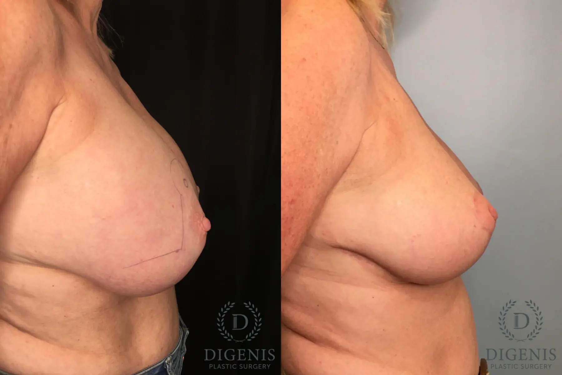 Breast Lift: Patient 32 - Before and After 3