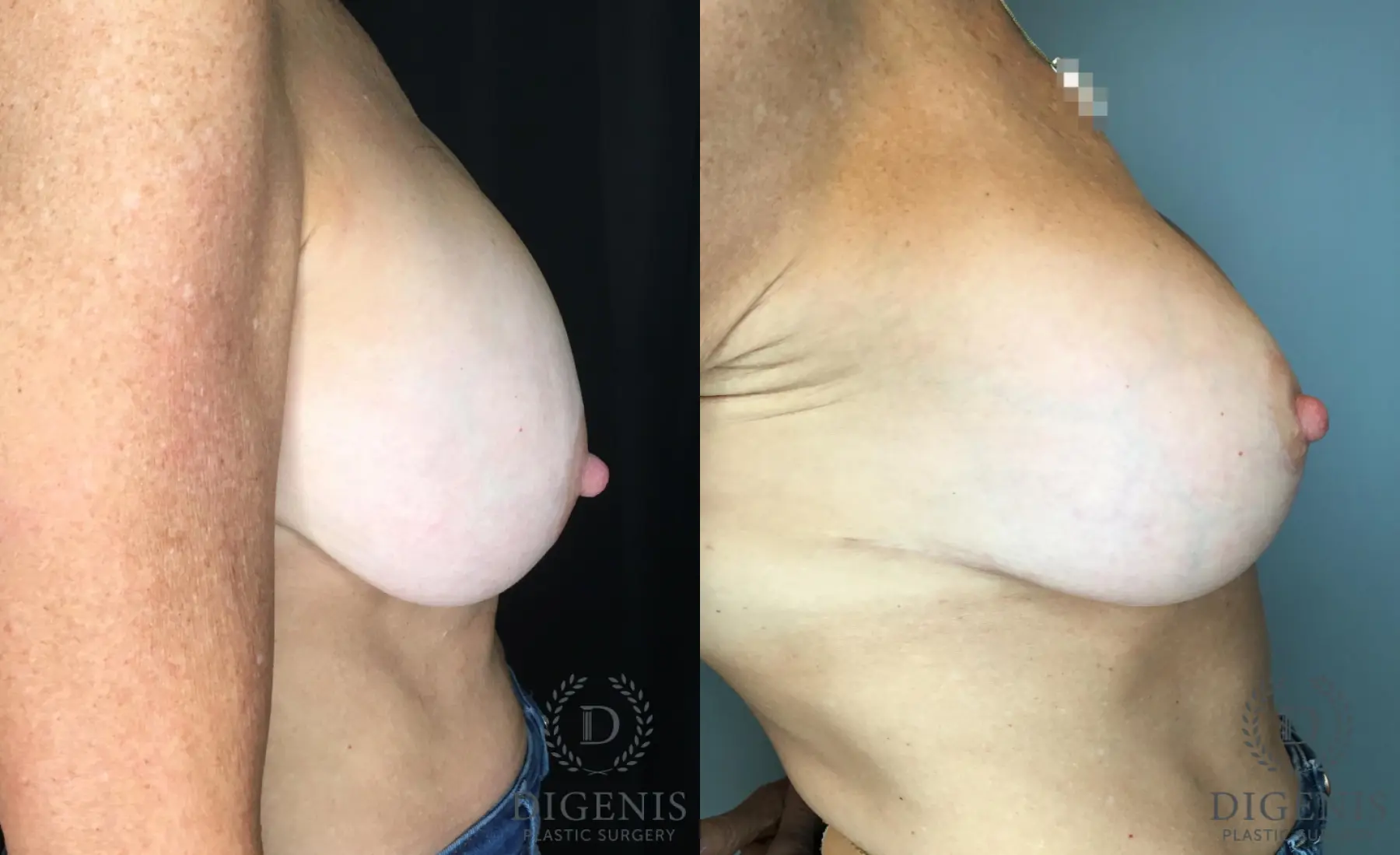 Breast Lift: Patient 45 - Before and After 5