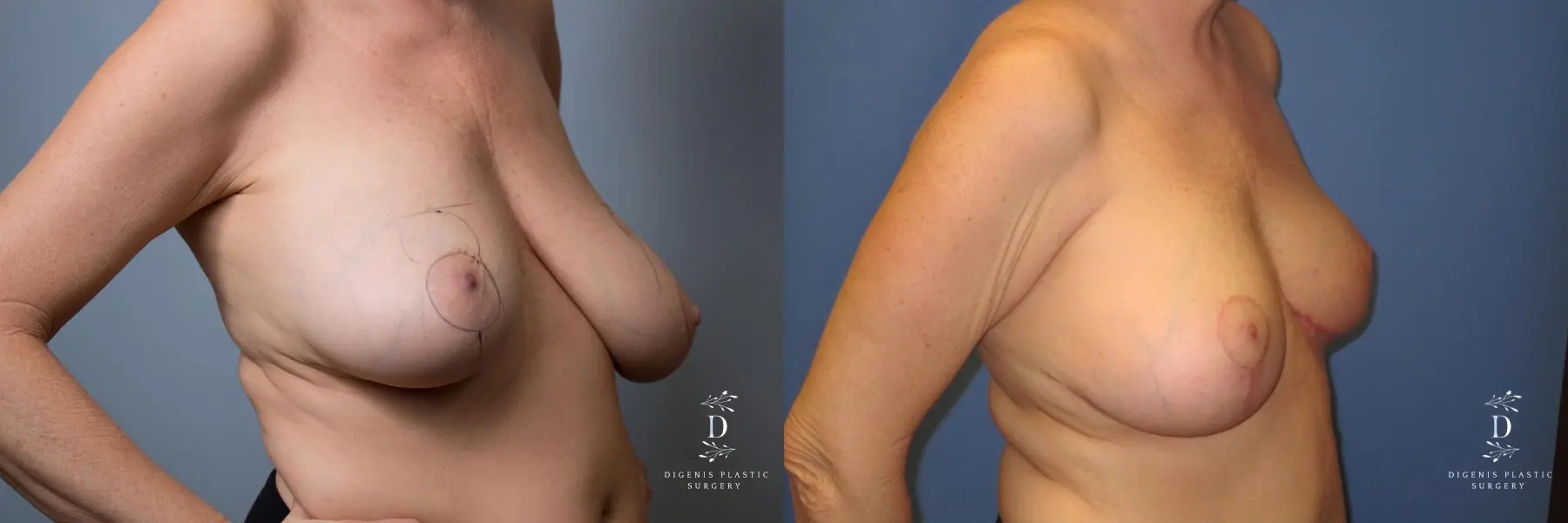 Breast Lift: Patient 6 - Before and After 2