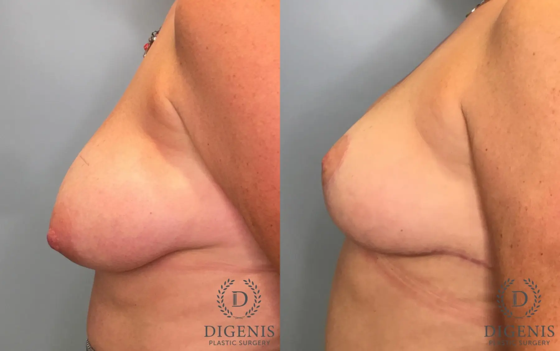 Breast Lift: Patient 42 - Before and After 5