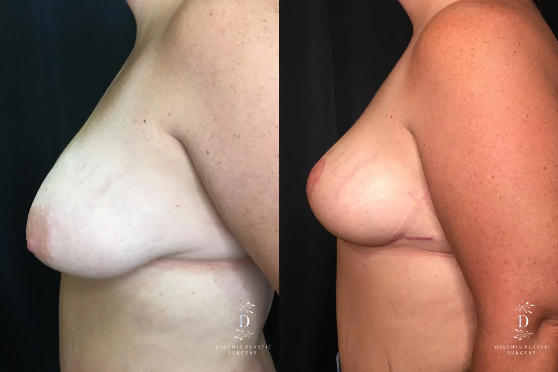 Breast Lift: Patient 10 - Before and After 5