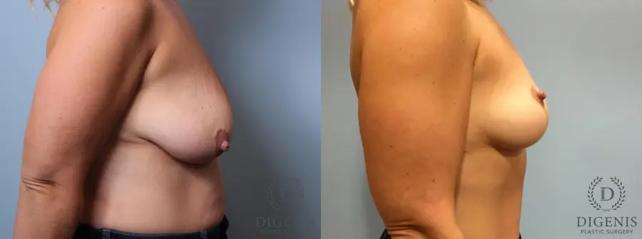 Breast Lift: Patient 4 - Before and After 3