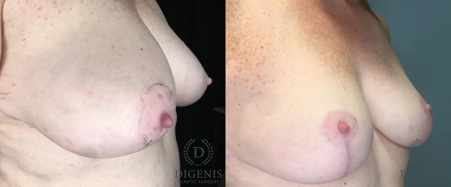 Breast Lift: Patient 35 - Before and After 4