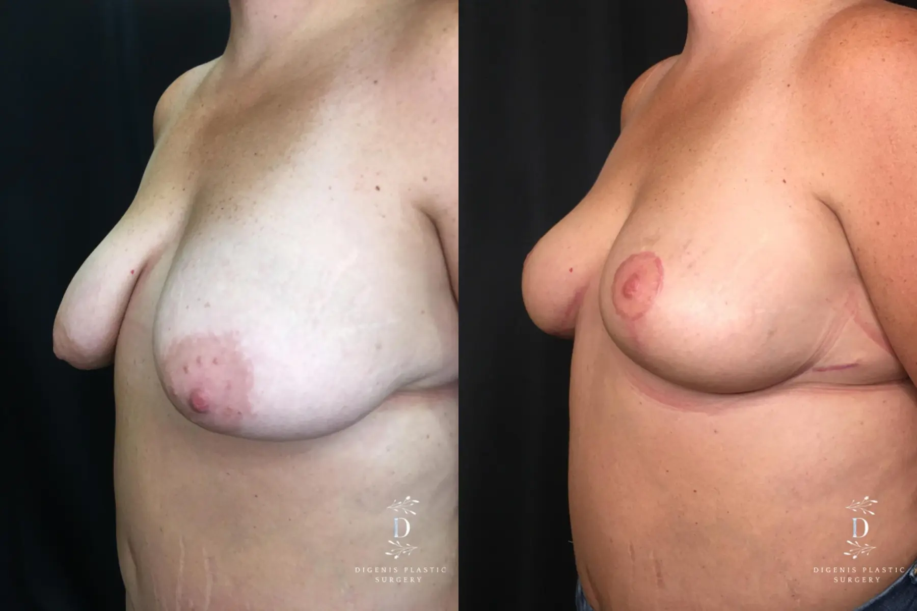 Breast Lift: Patient 10 - Before and After 4