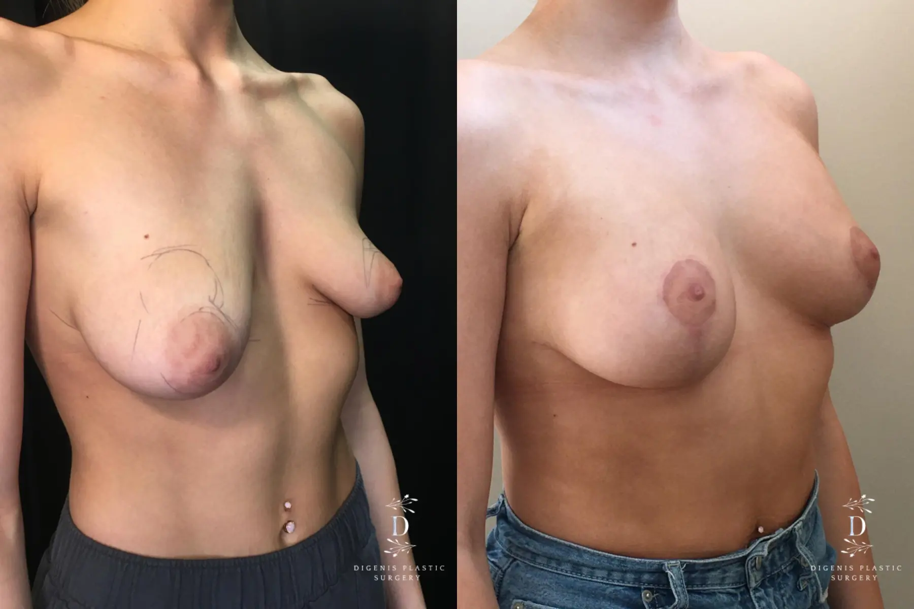 Breast Lift With Implants: Patient 14 - Before and After 2