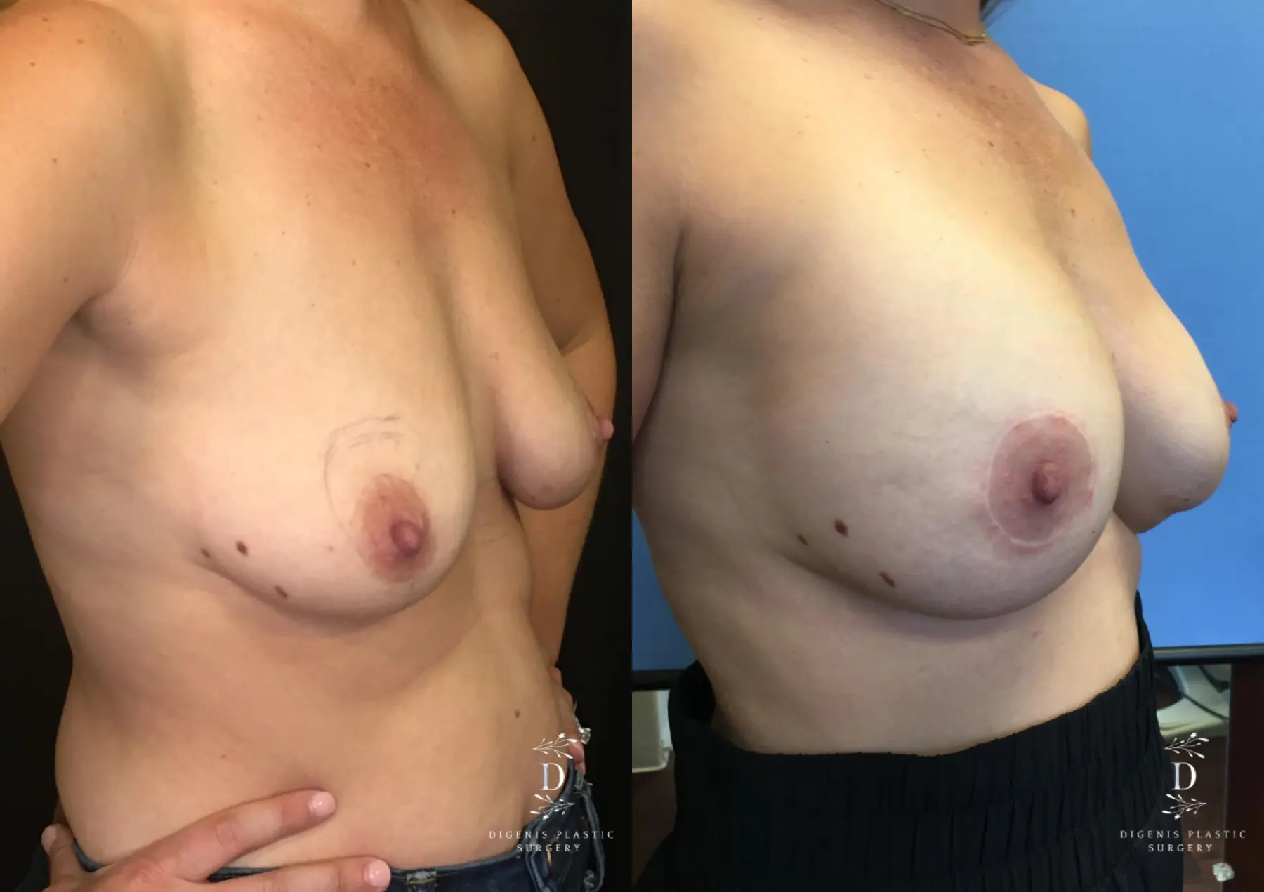 Breast Lift With Implants: Patient 11 - Before and After 2