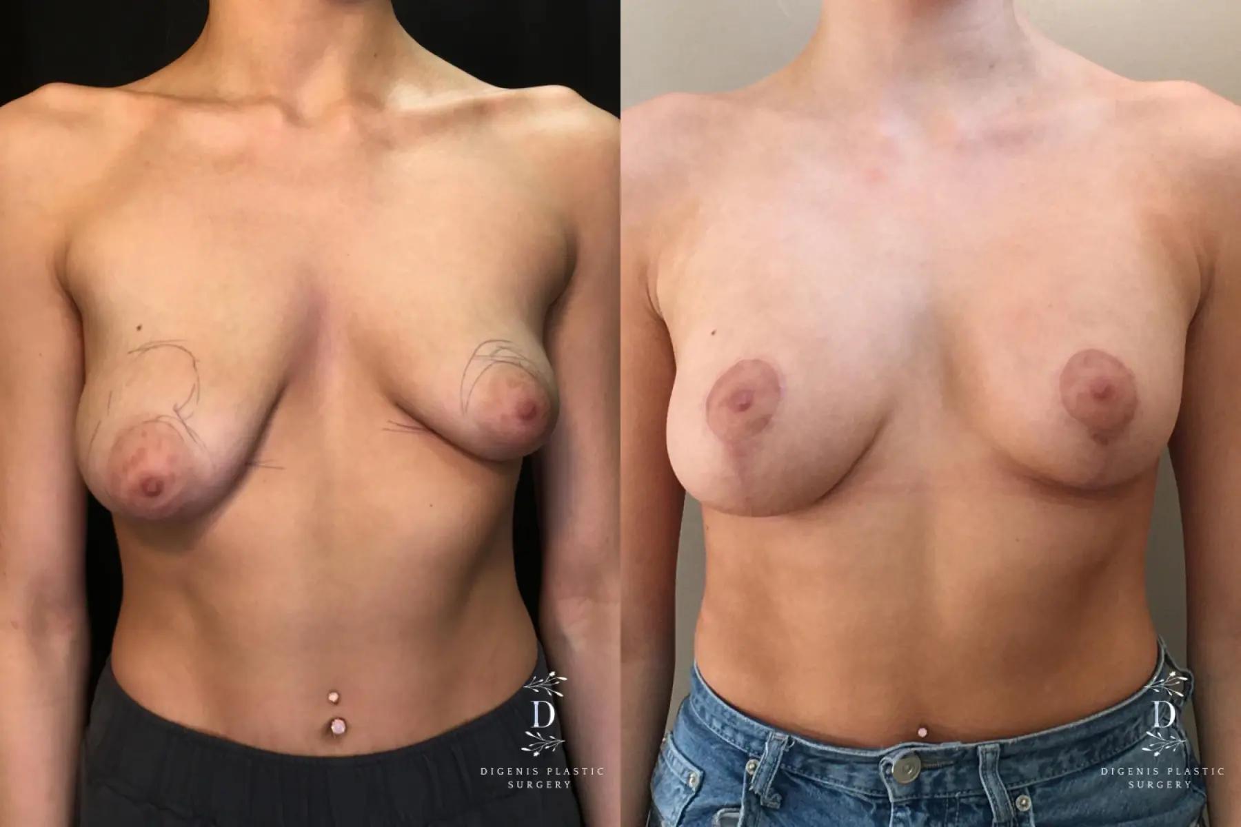 Breast Lift With Implants: Patient 14 - Before and After 1