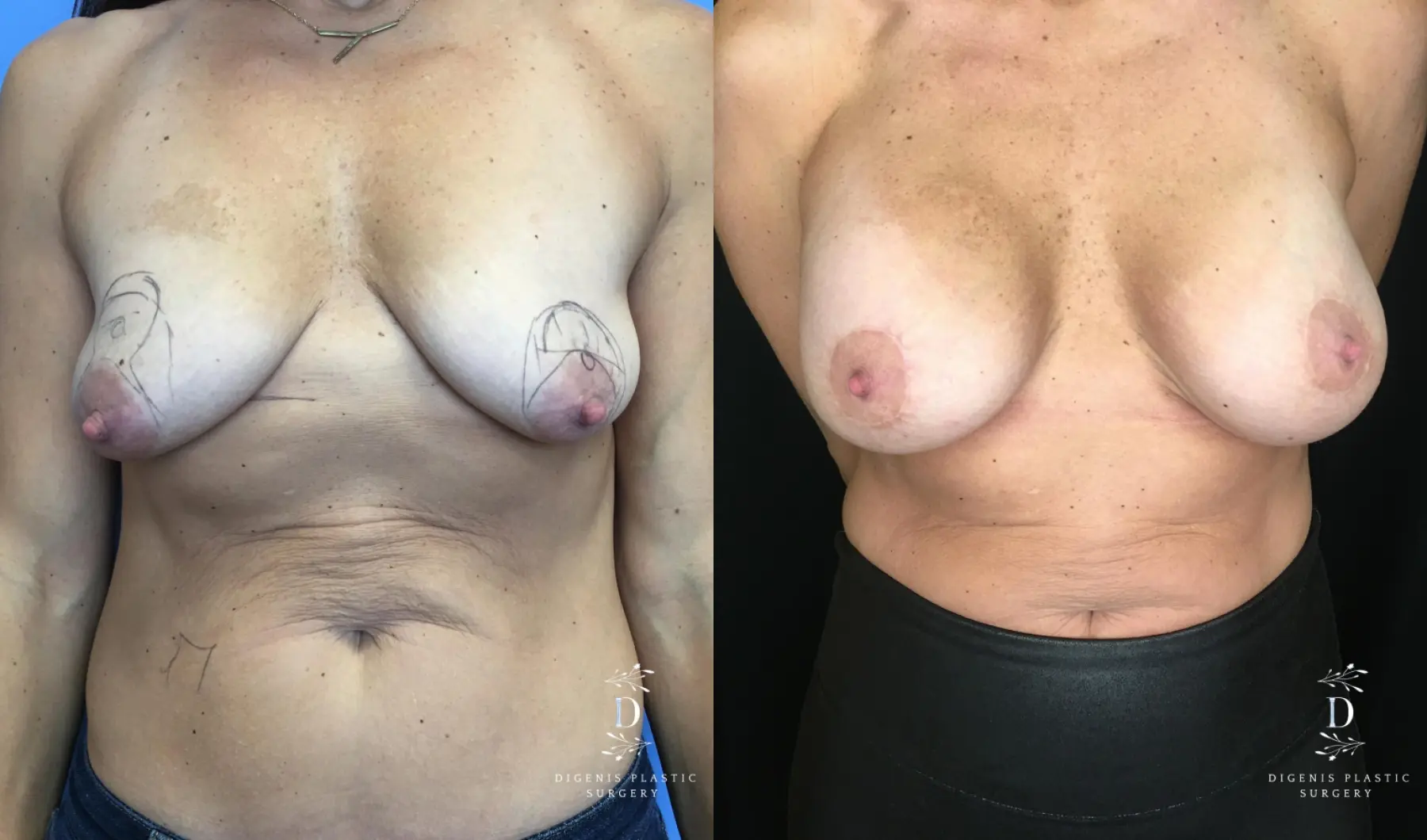 Breast Lift With Implants: Patient 13 - Before and After 1