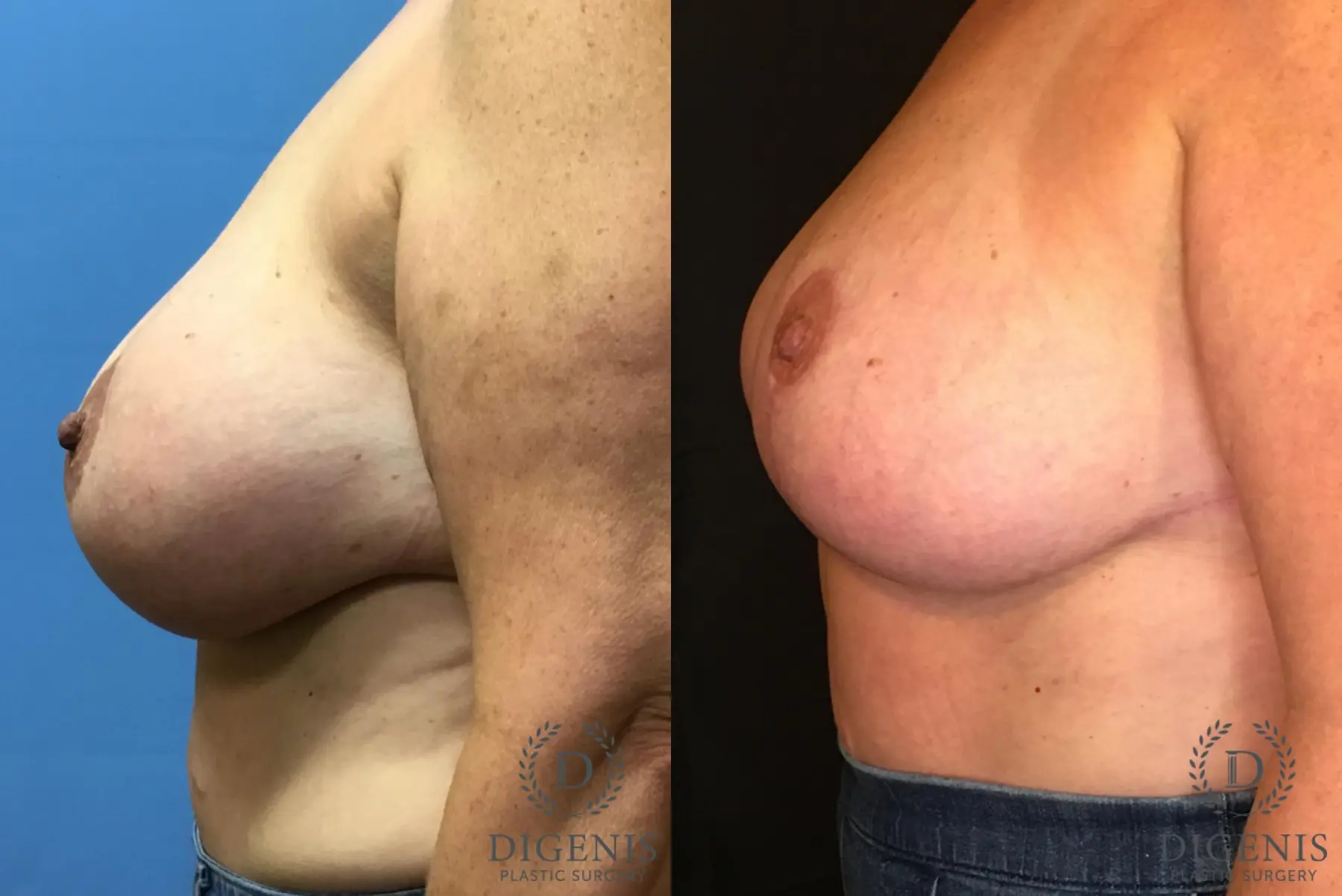 Breast Lift With Implants: Patient 4 - Before and After 4
