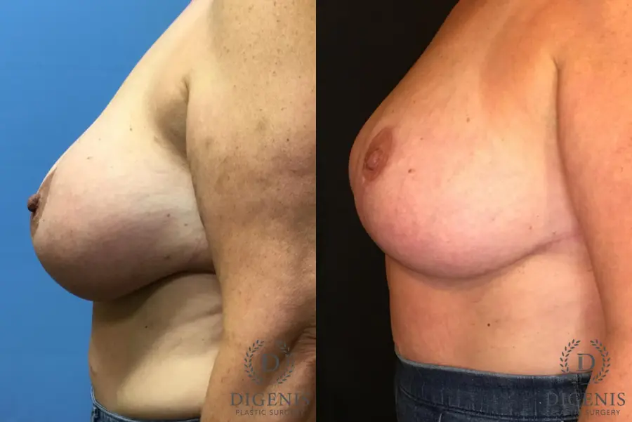 Breast Lift With Implants: Patient 4 - Before and After 4