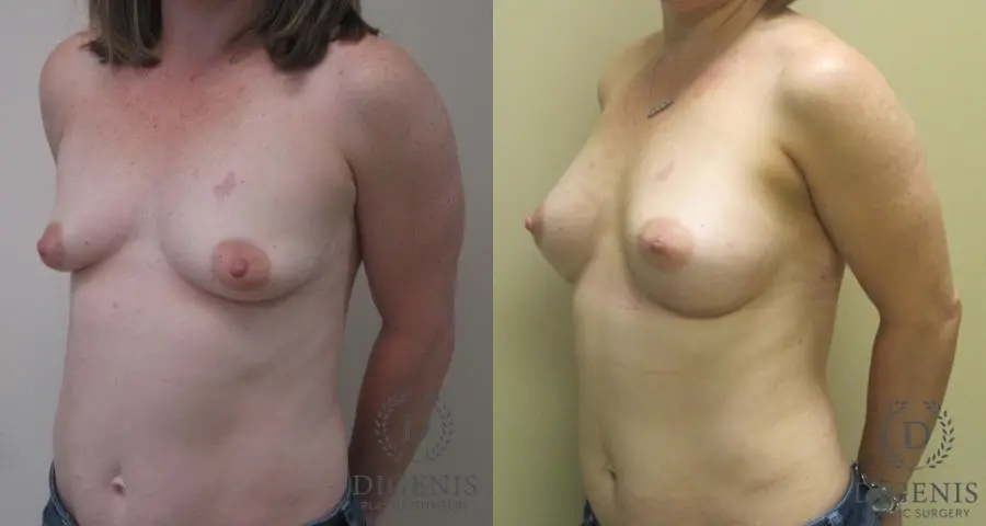 Breast Lift With Implants: Patient 1 - Before and After 4