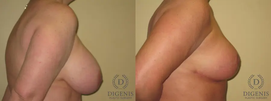 Breast Lift With Implants: Patient 7 - Before and After 3