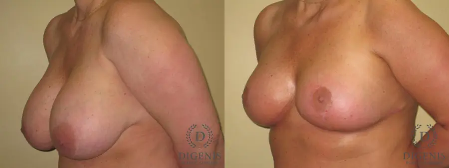 Breast Lift With Implants: Patient 7 - Before and After 4