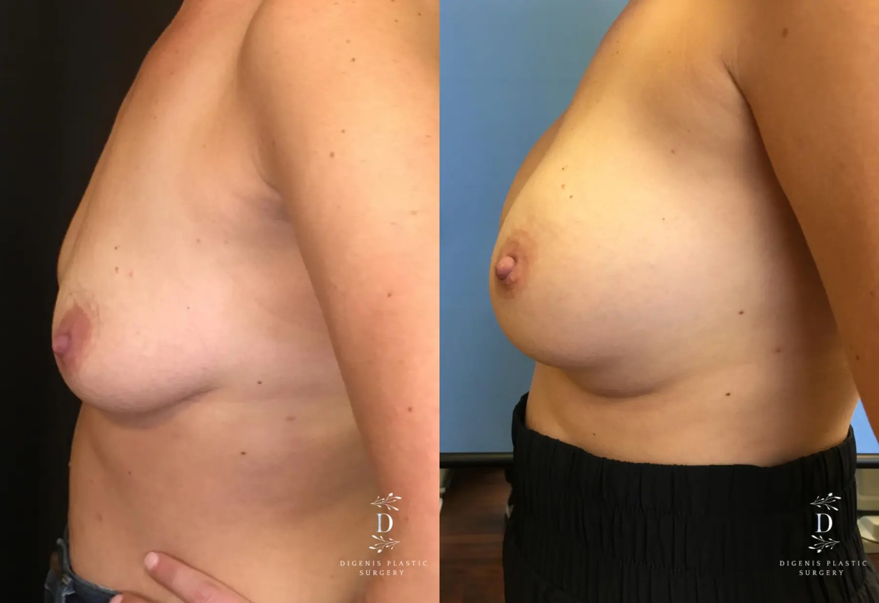 Breast Lift With Implants: Patient 11 - Before and After 5