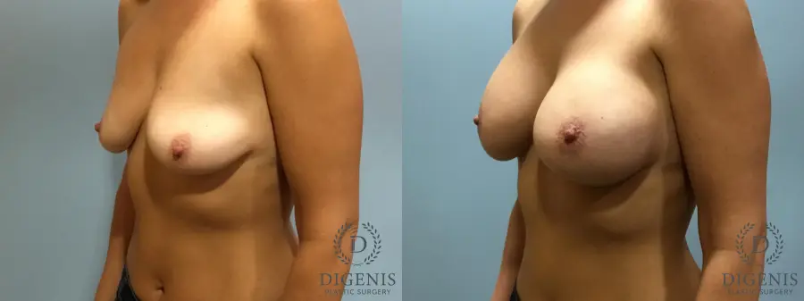 Breast Lift With Implants: Patient 5 - Before and After 4