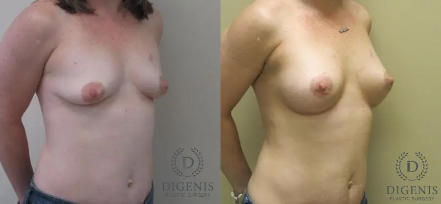 Breast Lift With Implants: Patient 1 - Before and After 2
