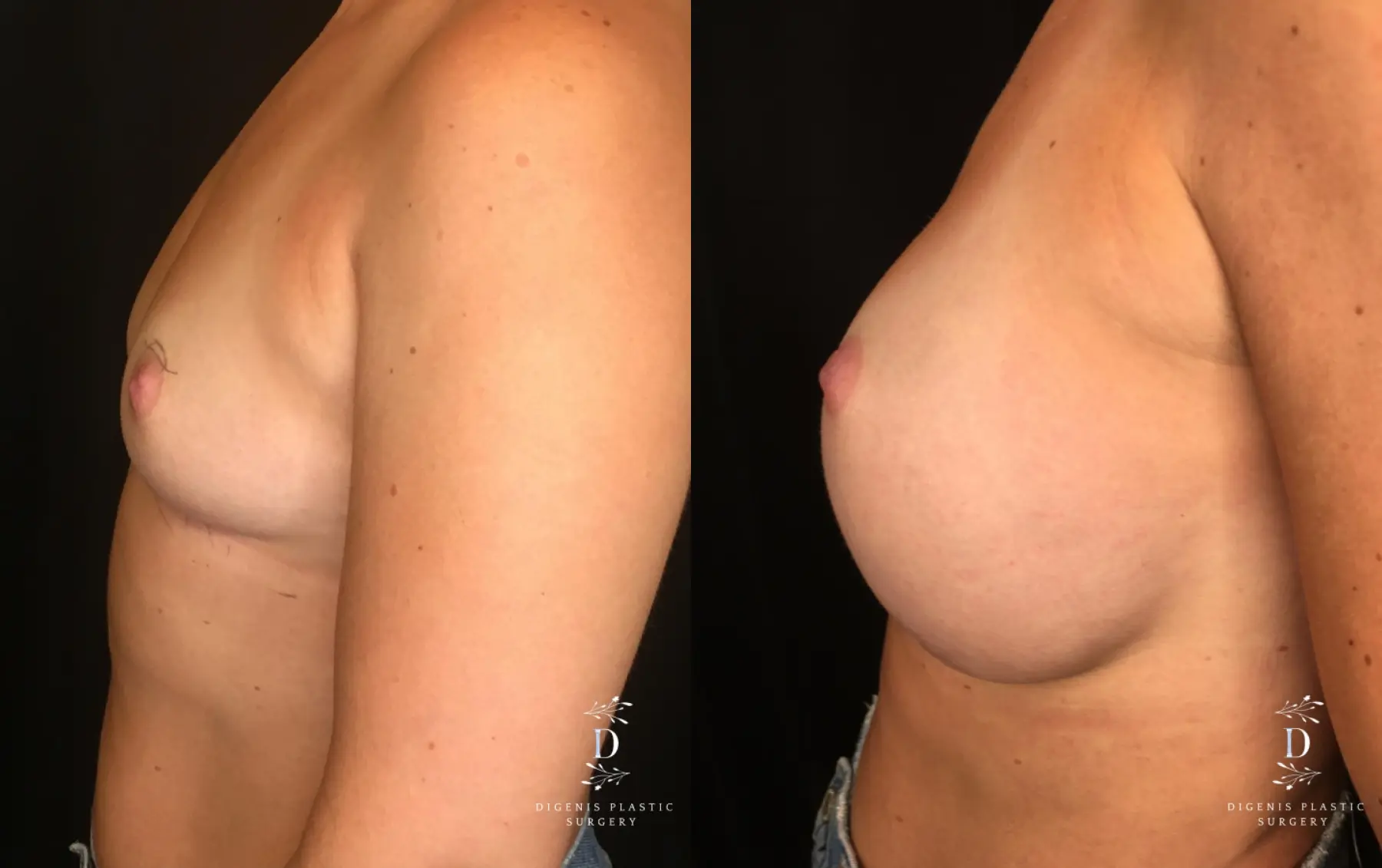 Breast Lift With Implants: Patient 10 - Before and After 5