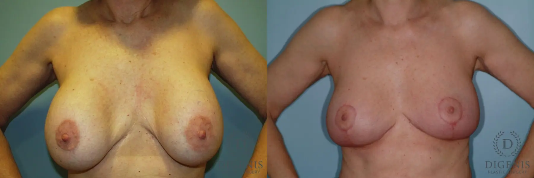 Breast Lift With Implants: Patient 6 - Before and After 1