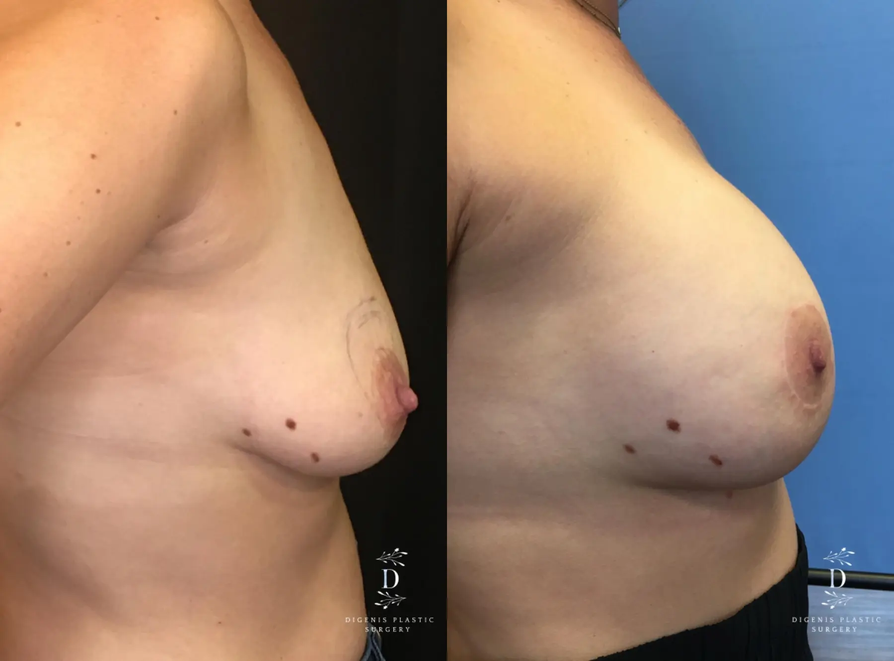 Breast Lift With Implants: Patient 11 - Before and After 3