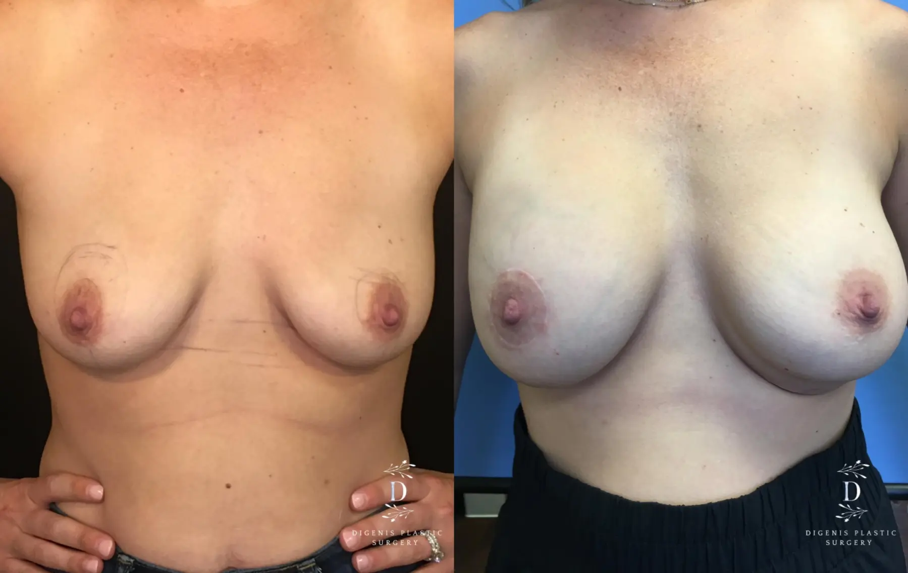 Breast Lift With Implants: Patient 11 - Before and After 1