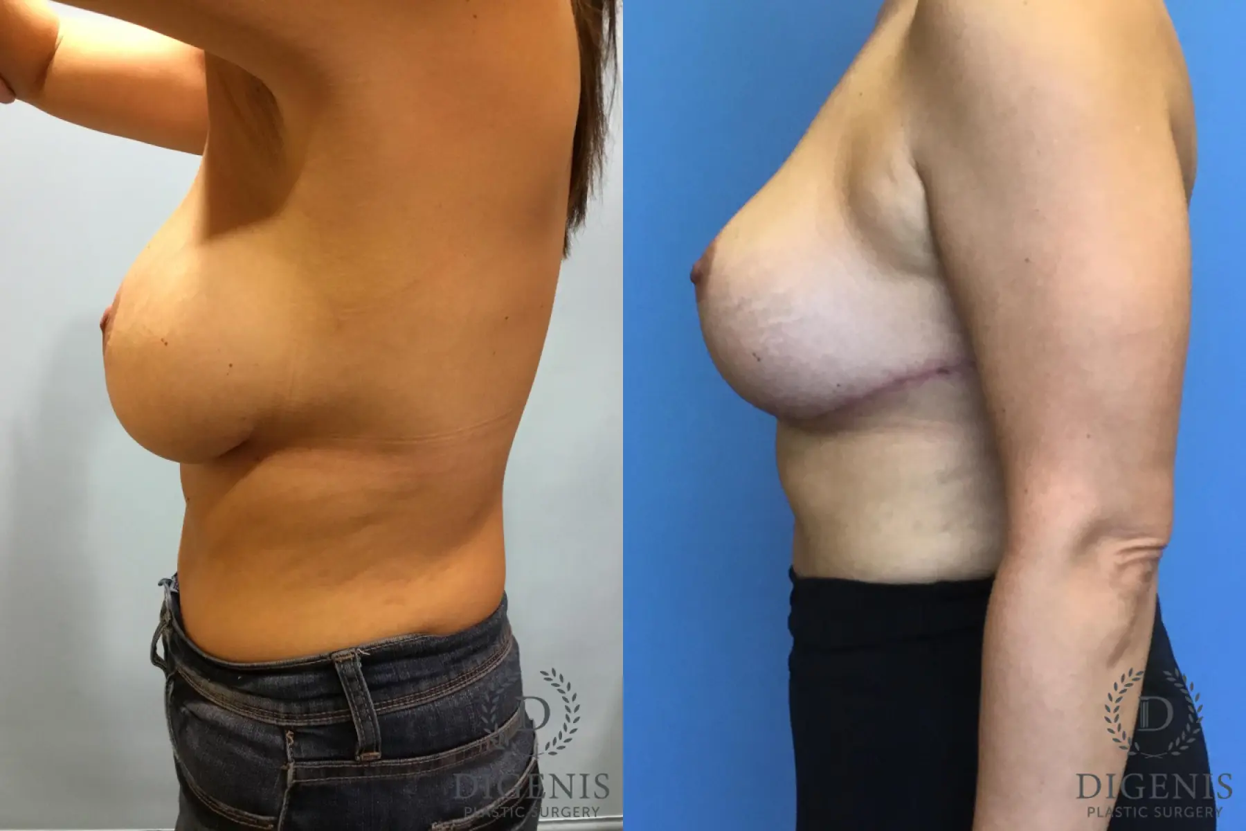 Breast Lift With Implants: Patient 2 - Before and After 3