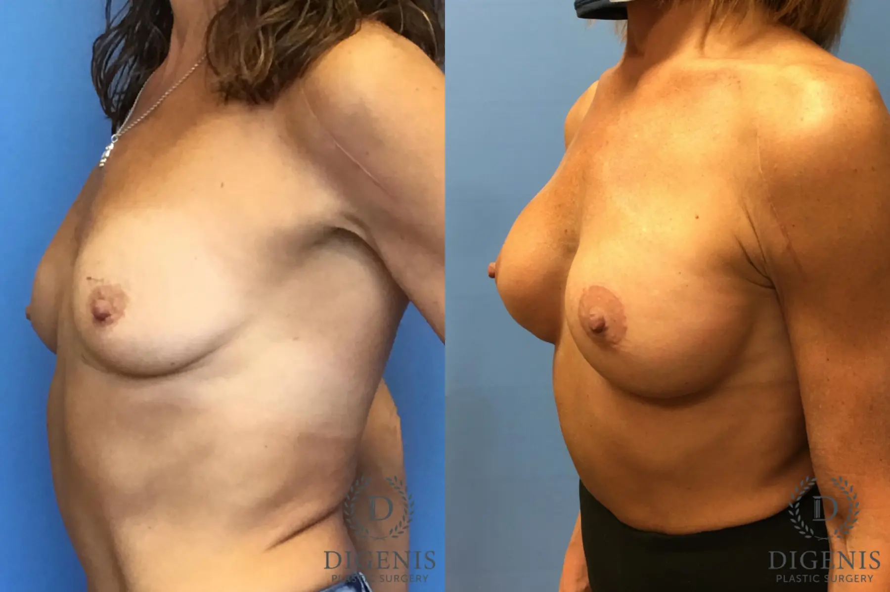Breast Lift With Implants: Patient 3 - Before and After 2