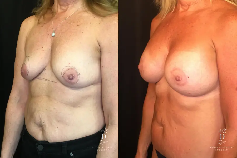 Breast Lift With Implants: Patient 8 - Before and After 4