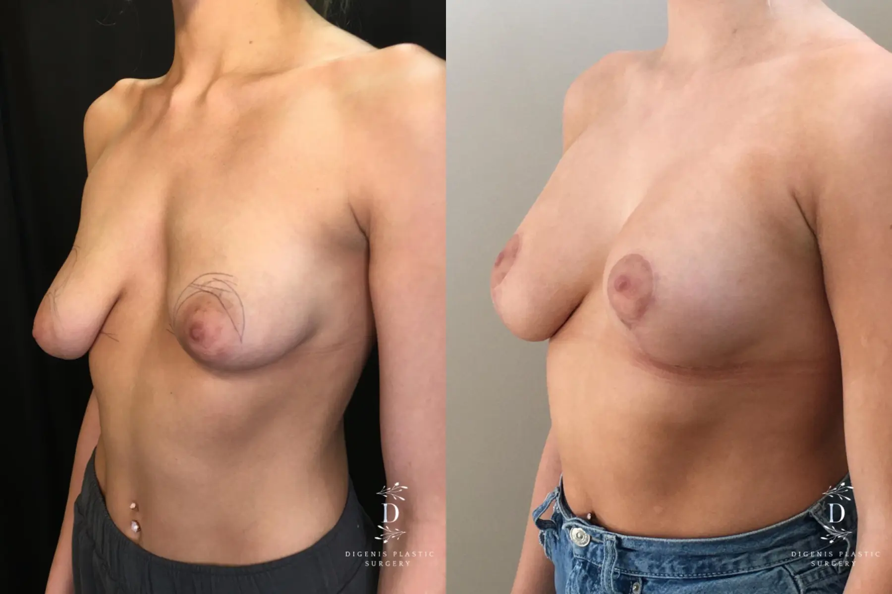 Breast Lift With Implants: Patient 14 - Before and After 4