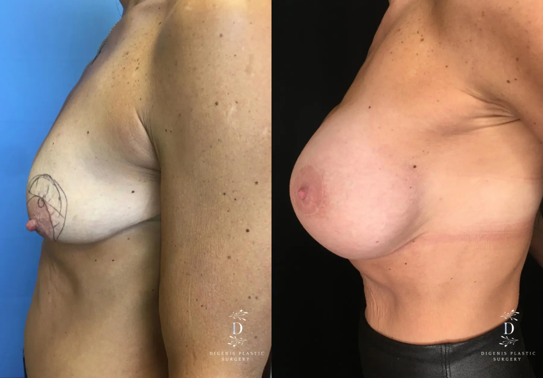Breast Lift With Implants: Patient 13 - Before and After 5