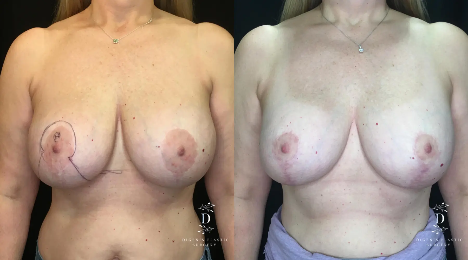 Breast Lift With Implants: Patient 9 - Before and After  