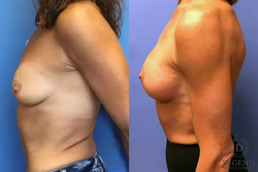 Breast Lift With Implants: Patient 3 - Before and After 3