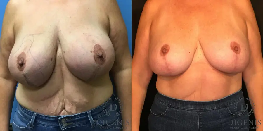 Breast Lift With Implants: Patient 4 - Before and After 1