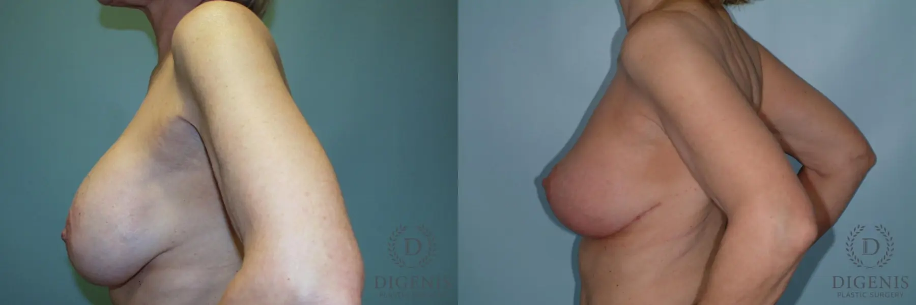 Breast Lift With Implants: Patient 6 - Before and After 5