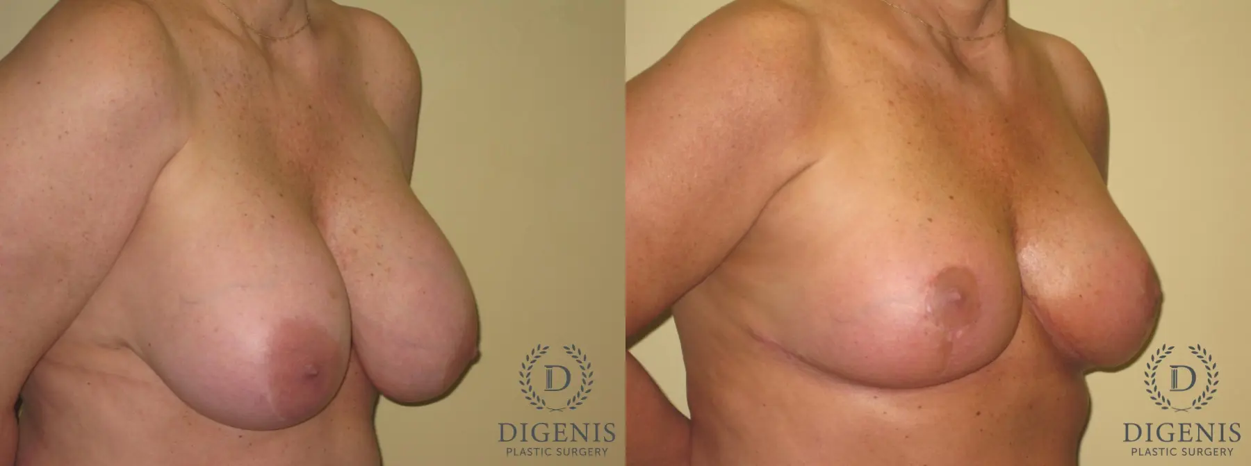 Breast Lift With Implants: Patient 7 - Before and After 2