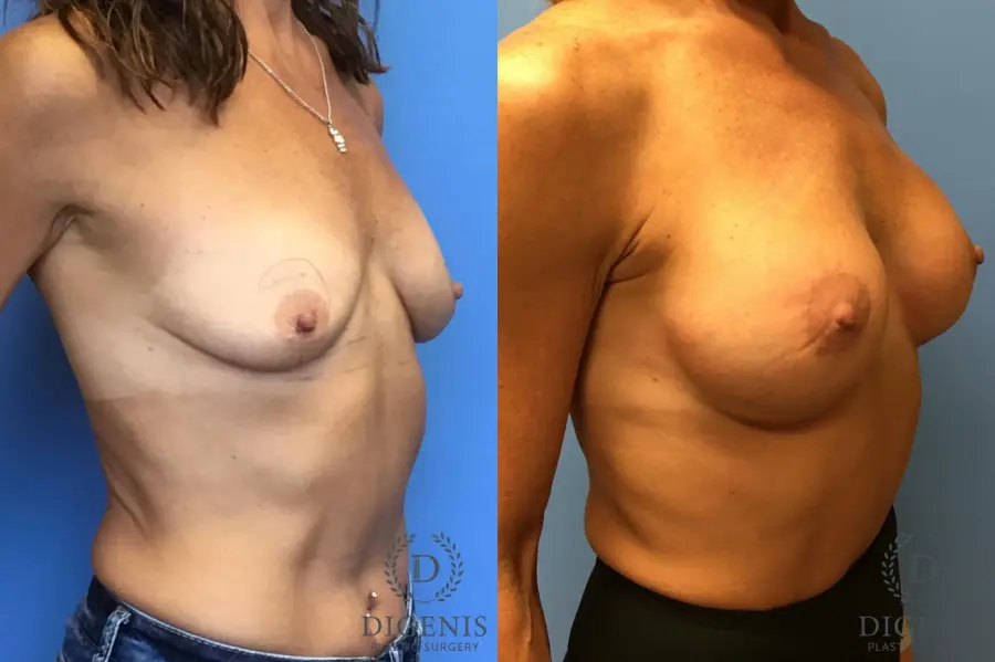 Breast Lift With Implants: Patient 3 - Before and After 4
