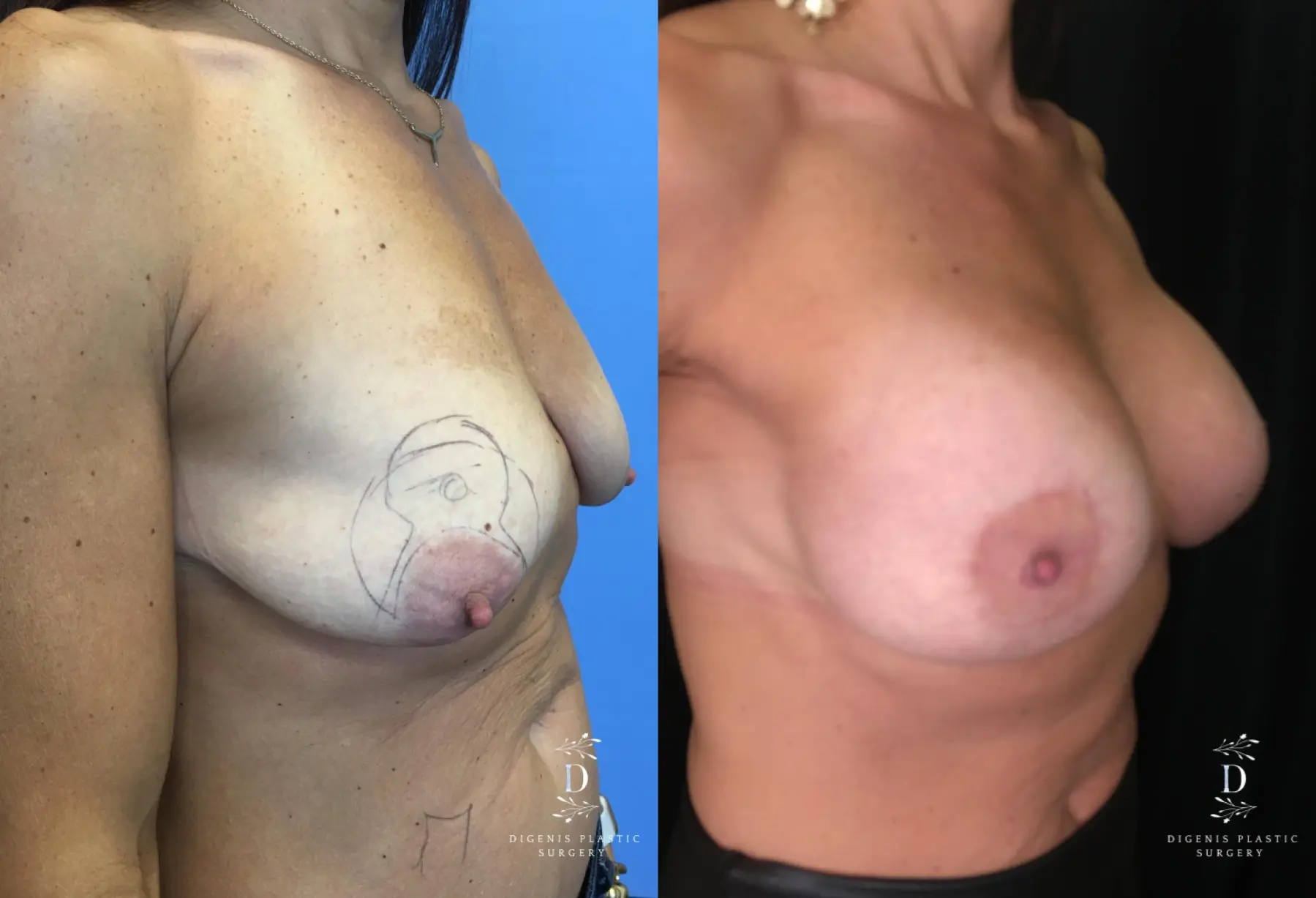 Breast Lift With Implants: Patient 13 - Before and After 2