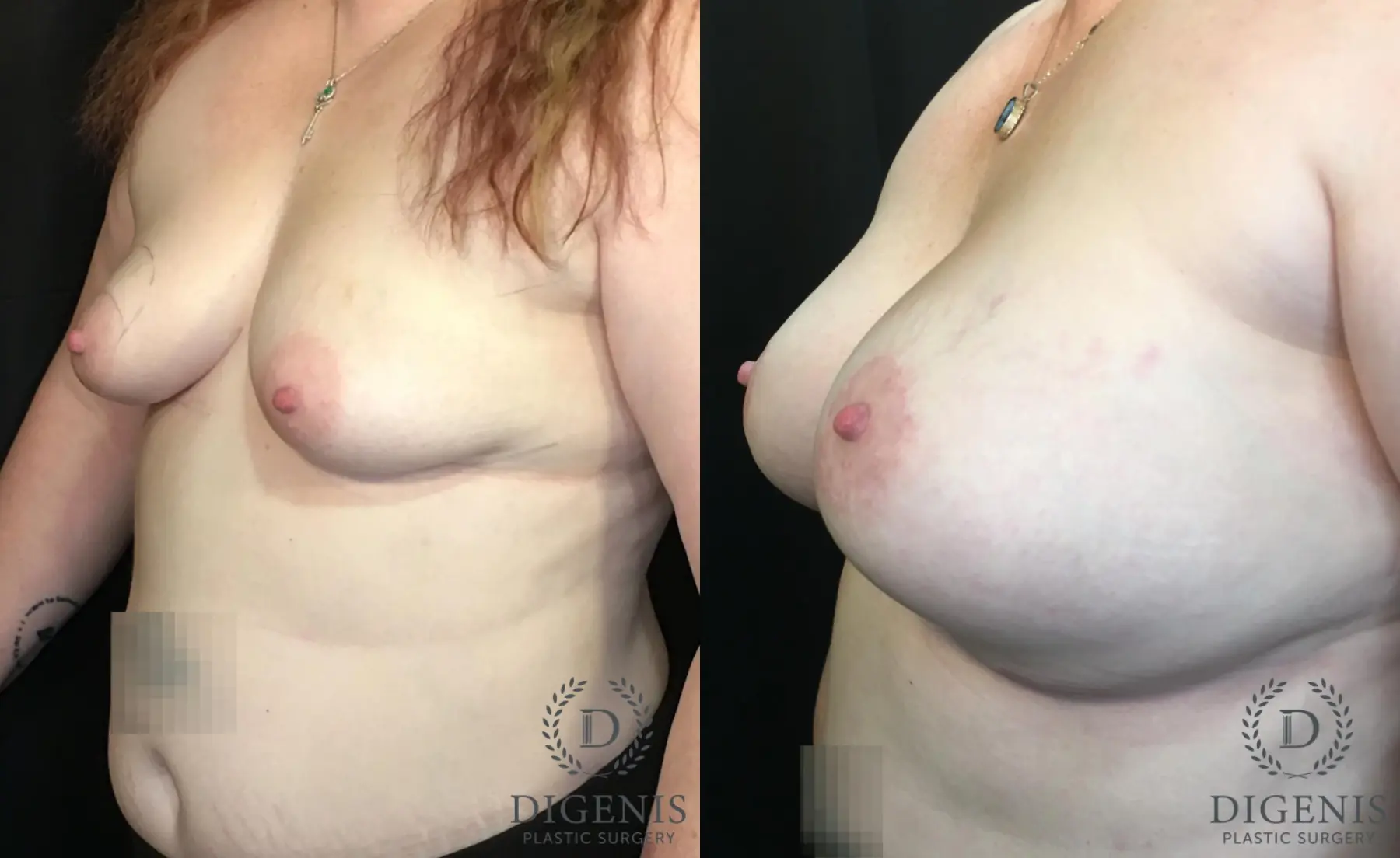 Breast Lift With Implants: Patient 12 - Before and After 4