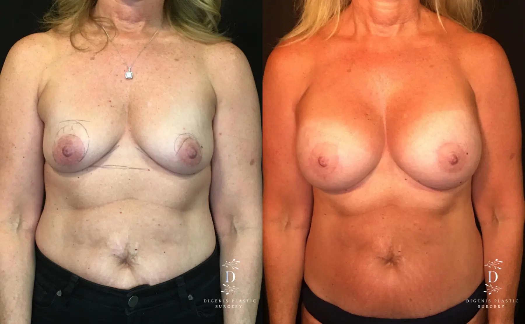 Breast Lift With Implants: Patient 8 - Before and After  
