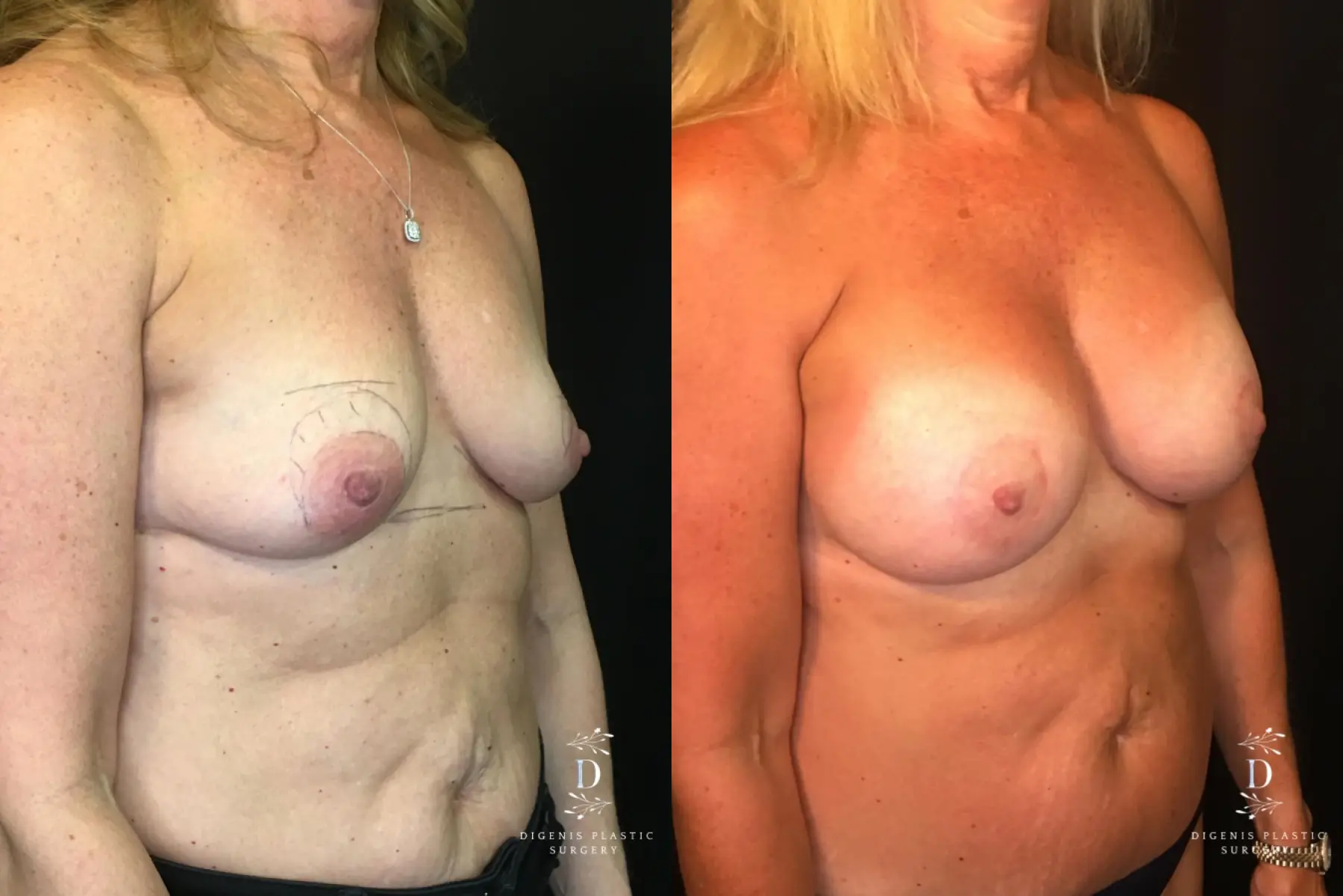 Breast Lift With Implants: Patient 8 - Before and After 2
