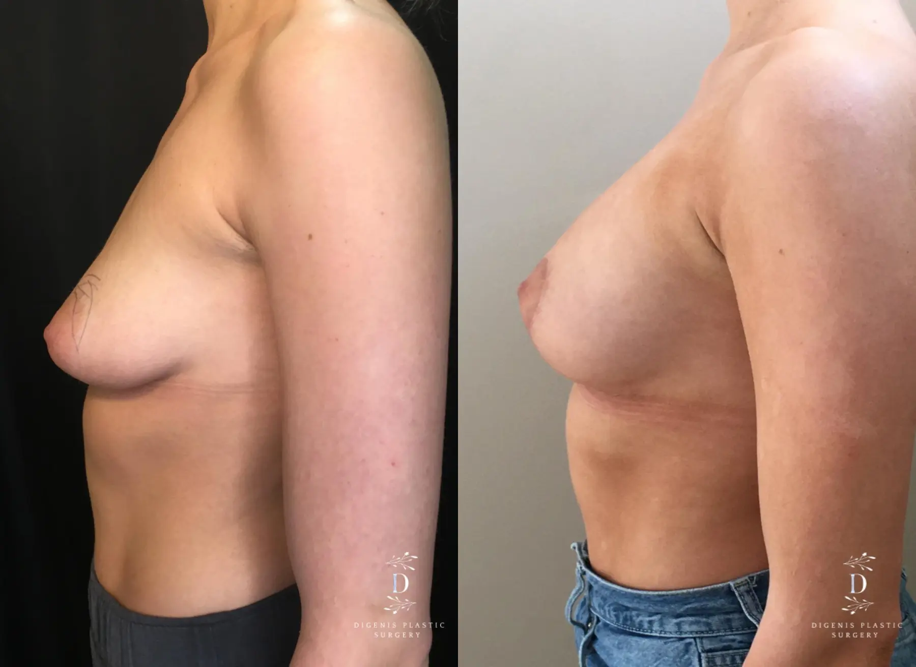 Breast Lift With Implants: Patient 14 - Before and After 5
